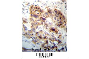 PI15 Antibody immunohistochemistry analysis in formalin fixed and paraffin embedded human breast carcinoma followed by peroxidase conjugation of the secondary antibody and DAB staining. (PI15 anticorps  (N-Term))