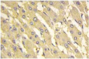 Immunohistochemistry: PFK-2 liv antibody staining of Paraffin-Embedded Human liver carcinoma tissue. (PFKFB1 anticorps)
