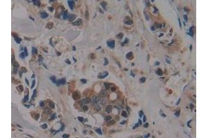 Detection of PSMD9 in Human Breast cancer Tissue using Polyclonal Antibody to Proteasome 26S Subunit, Non ATPase 9 (PSMD9)