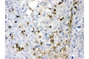 IHC testing of FFPE human liver cancer tissue with CA2 antibody at 1ug/ml. (CA2 anticorps)