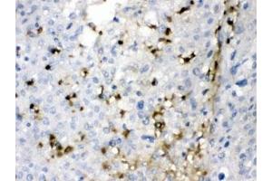 IHC testing of FFPE human liver cancer tissue with CA2 antibody at 1ug/ml.