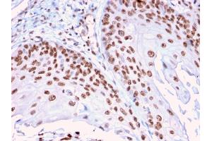 Formalin-fixed, paraffin-embedded human Cervical Carcinoma stained with CLEC9A Mouse Monoclonal Antibody (2H12/4). (DMC1 anticorps)
