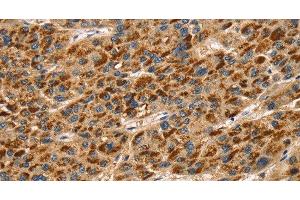 Immunohistochemistry of paraffin-embedded Human liver cancer using TLN1 Polyclonal Antibody at dilution of 1:30 (TLN1 anticorps)
