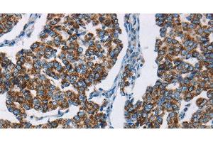 Immunohistochemistry of paraffin-embedded Human breast cancer using HINT2 Polyclonal Antibody at dilution of 1:50