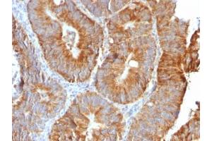 IHC testing of FFPE human colon carcinoma with recombinant TNFSF15 antibody (clone VEGI/2052R).