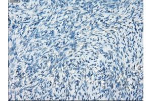 Immunohistochemical staining of paraffin-embedded Adenocarcinoma of breast tissue using anti-PRKAR1A mouse monoclonal antibody. (PRKAR1A anticorps)