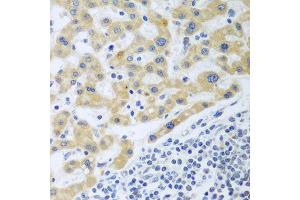 Immunohistochemistry of paraffin-embedded human liver cancer using SHBG antibody at dilution of 1:100 (40x lens).