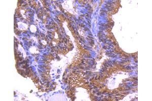 Paraformaldehyde-fixed, paraffin embedded human colon cancer, Antigen retrieval by boiling in sodium citrate buffer (pH6.