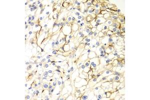 Immunohistochemistry of paraffin-embedded human kidney cancer using V antibody (ABIN6132779, ABIN6150054, ABIN6150055 and ABIN6223794) at dilution of 1:100 (40x lens). (VANGL2 anticorps  (AA 1-110))
