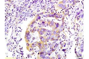 Formalin-fixed and paraffin-embedded : human colon carcinoma labeled with Rabbit Anti-WNK3 protein Polyclonal Antibody , Unconjugated 1:200 followed by conjugation to the secondary antibody (WNK3 anticorps  (AA 451-550))