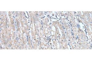 Immunohistochemistry of paraffin-embedded Human gastric cancer tissue using SPTA1 Polyclonal Antibody at dilution of 1:80(x200) (SPTA1 anticorps)