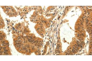 Immunohistochemistry of paraffin-embedded Human colon cancer tissue using TRPM7 Polyclonal Antibody at dilution 1:30