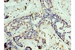 Immunohistochemistry of paraffin-embedded human breast cancer using ABIN7153848 at dilution of 1:100 (GAN anticorps  (AA 1-240))