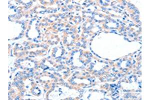 The image on the left is immunohistochemistry of paraffin-embedded Human thyroid cancer tissue using ABIN7128170(ACOX1 Antibody) at dilution 1/20, on the right is treated with fusion protein. (ACOX1 anticorps)