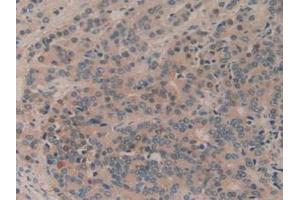 IHC-P analysis of Human Prostate Gland Cancer Tissue, with DAB staining. (MTOR anticorps  (AA 2226-2488))