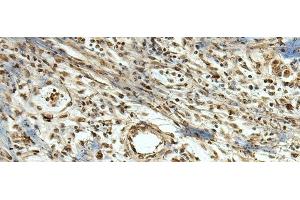 Immunohistochemistry of paraffin-embedded Human breast cancer tissue using MLF1 Polyclonal Antibody at dilution of 1:105(x200) (MLF1 anticorps)
