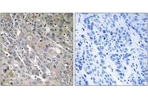 Immunohistochemistry analysis of paraffin-embedded human lung carcinoma tissue, using ARHGEF9 Antibody.