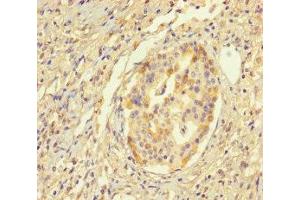 Immunohistochemistry of paraffin-embedded human pancreatic cancer using ABIN7155943 at dilution of 1:100 (Chromosome X Open Reading Frame 27 (CXORF27) (AA 1-117) anticorps)