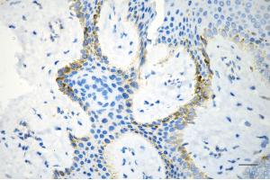 Immunohistochemistry was performed on paraffin-embedded human hemangioma using STAT5A antibody (ABIN7800347), 1:200). (Recombinant STAT5A anticorps)