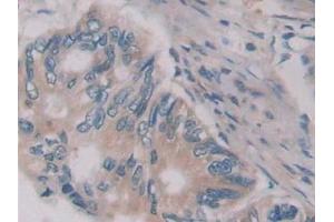 Detection of JAG2 in Human Colorectal cancer Tissue using Polyclonal Antibody to Jagged 2 Protein (JAG2)