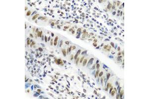 Immunohistochemistry of paraffin-embedded human colon carcinoma using CASP9 antibody (ABIN4903132) at dilution of 1:100 (40x lens). (Caspase 9 anticorps)
