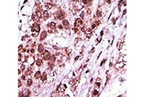 IHC analysis of FFPE human hepatocarcinoma tissue stained with the GSK3B antibody (GSK3 beta anticorps  (AA 4-34))