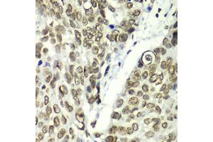 Immunohistochemistry of paraffin-embedded human esophageal cancer using TEAD1 antibody (ABIN6291475) at dilution of 1:100 (40x lens).