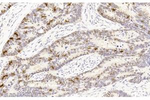 Immunohistochemical analysis of paraffin-embedded Human Colon cancer section using Pink1 (ABIN6242405 and ABIN6577209). (p53 anticorps  (AA 1-393))