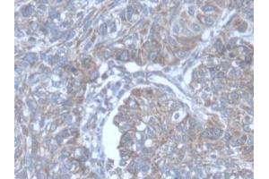 Detection of POFUT1 in Human Lung cancer Tissue using Polyclonal Antibody to Protein O-Fucosyltransferase 1 (POFUT1) (POFUT1 anticorps  (AA 238-388))