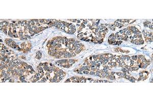 Immunohistochemistry of paraffin-embedded Human esophagus cancer tissue using CADM2 Polyclonal Antibody at dilution of 1:40(x200)