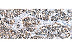 Immunohistochemistry of paraffin-embedded Human esophagus cancer tissue using CADM2 Polyclonal Antibody at dilution of 1:40(x200) (CADM2 anticorps)