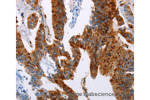 Immunohistochemistry of Human colon cancer using TFF3 Polyclonal Antibody at dilution of 1:50 (TFF3 anticorps)