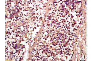 Formalin-fixed and paraffin embedded human lung carcinoma labeled with Anti-Phospho-RSK2 (Ser227) Polyclonal Antibody, Unconjugated (ABIN745268) at 1:200 followed by conjugation to the secondary antibody and DAB staining