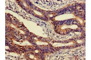 Immunohistochemistry of paraffin-embedded human colon cancer using ABIN7146807 at dilution of 1:100 (CEACAM7 anticorps  (AA 36-242))