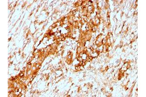 Formalin-fixed, paraffin-embedded human Breast stained with Alpha-1-Antitrypsin Recombinant Rabbit Monoclonal Antibody (AAT/3167R). (Recombinant SERPINA1 anticorps)