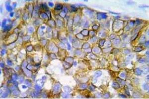 Immunohistochemistry (IHC) analyzes of p-Crk2 antibody in paraffin-embedded human lung adenocarcinoma tissue. (Crk anticorps  (pTyr221))