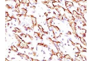 IHC testing of angiosarcoma stained with Podocalyxin antibody. (PODXL anticorps  (Extracellular Domain))