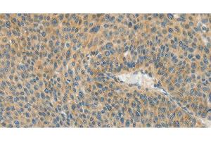 Immunohistochemistry of paraffin-embedded Human liver cancer using ASPA Polyclonal Antibody at dilution of 1:80 (ASPA anticorps)