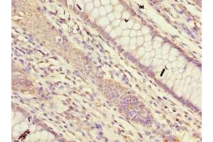 Immunohistochemistry of paraffin-embedded human colon cancer using ABIN7165410 at dilution of 1:100 (FAM149B1 anticorps  (AA 107-528))