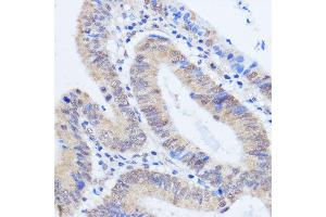 Immunohistochemistry of paraffin-embedded human colon carcinoma using RBM39 antibody (ABIN7270085) at dilution of 1:100 (40x lens).