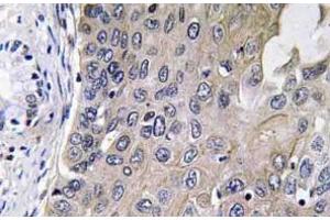 Immunohistochemistry analysis of GCS-alpha-1 antibody in paraffin-embedded human lung carcinoma tissue. (GUCY1A1 anticorps)