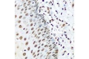 Immunohistochemical analysis of hnRNP R staining in human esophageal cancer formalin fixed paraffin embedded tissue section. (HNRNPR anticorps)