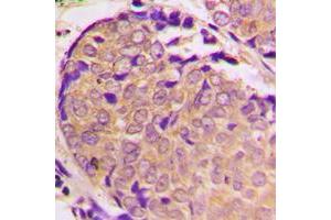 Immunohistochemical analysis of Alpha-synuclein (pS129) staining in human prostate cancer formalin fixed paraffin embedded tissue section.