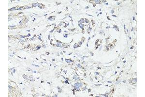 Immunohistochemistry of paraffin-embedded human gastric cancer using MAP1LC3B antibody (ABIN6291774) at dilution of 1:100 (40x lens). (LC3B anticorps)