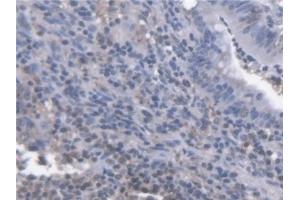 Detection of CXCL14 in Human Colorectal cancer Tissue using Polyclonal Antibody to Chemokine (C-X-C Motif) Ligand 14 (CXCL14)