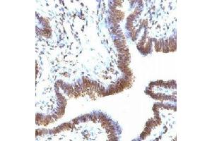 IHC testing of FFPE human ovarian carcinoma and EMI-1 antibody (FBXP5). (FBXO5 anticorps  (N-Term))