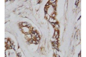 Anti-CDC42 antibody, IHC(P) IHC(P): Human Mammary Cancer Tissue (CDC42 anticorps  (Middle Region))