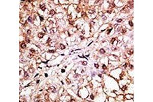 IHC analysis of FFPE human hepatocarcinoma tissue stained with the BNIP3L antibody (BNIP3L/NIX anticorps  (AA 122-152))