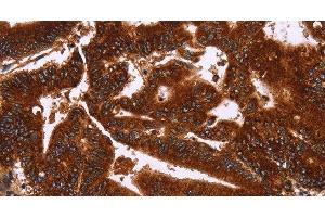 Immunohistochemistry of paraffin-embedded Human colon cancer tissue using GCKR Polyclonal Antibody at dilution 1:50 (GCKR anticorps)