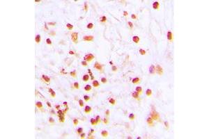 Immunohistochemical analysis of ERCC6 staining in human lung cancer formalin fixed paraffin embedded tissue section. (ERCC6 anticorps  (N-Term))